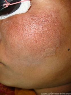 Acne Scar Co2 Fraxel